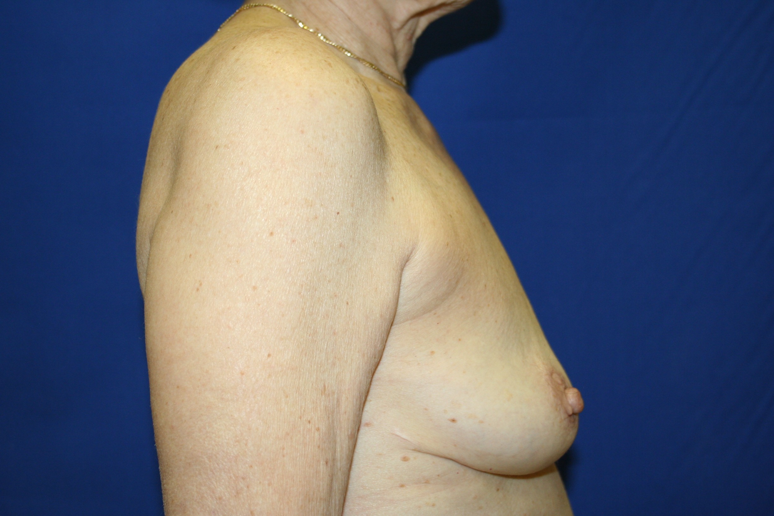 NJ Breast Explant  Breast Implant Removal New Jersey